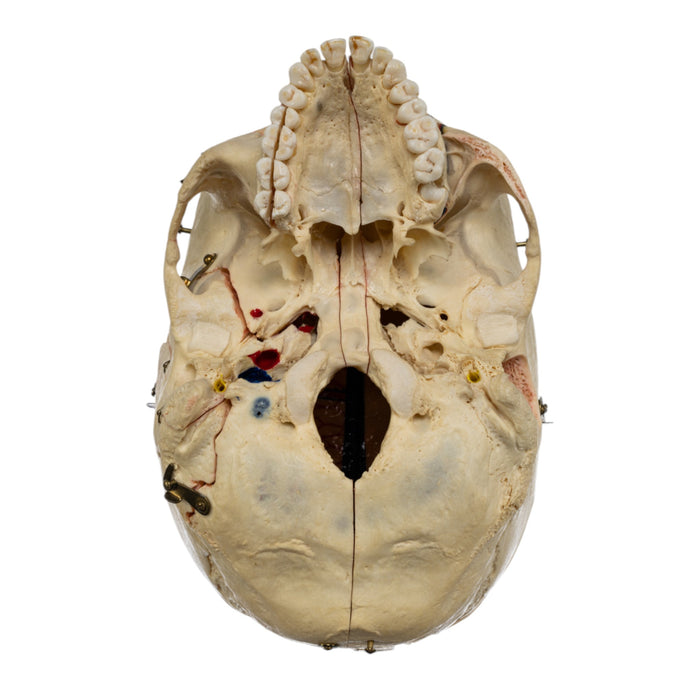 Real Human Dissected Skull in Carrying Case