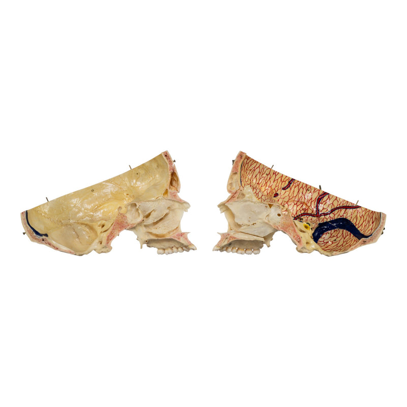 Real Human Dissected Skull in Carrying Case