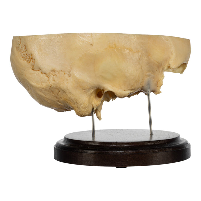 Real Human Partial Skull on Stand