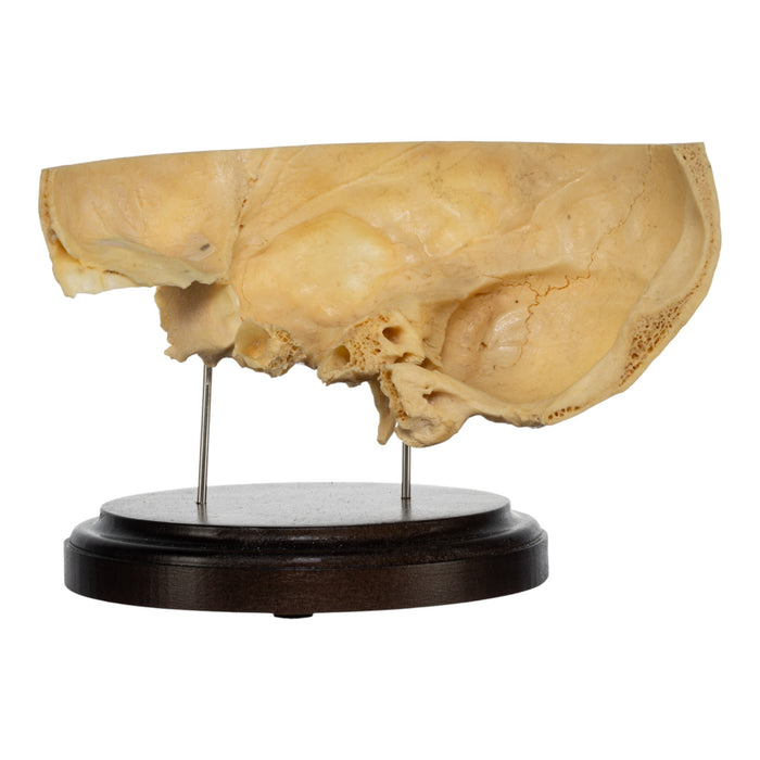 Real Human Partial Skull on Stand