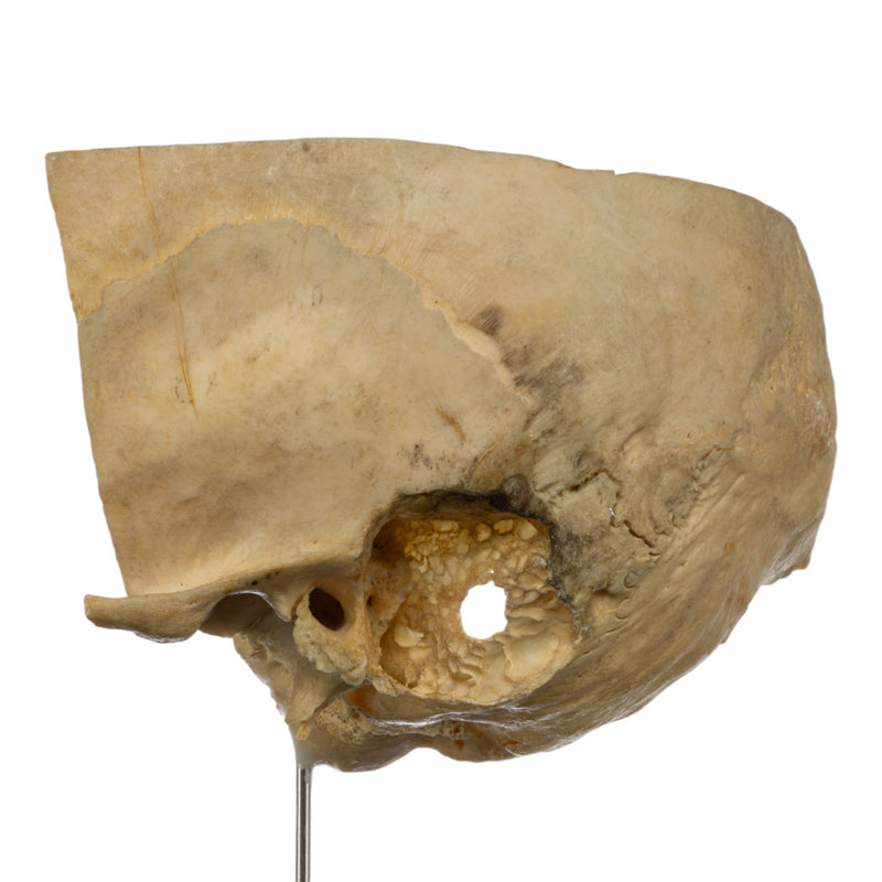 Real Human Partial Skull on Stand