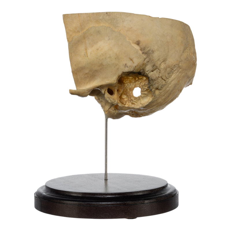 Real Human Partial Skull on Stand