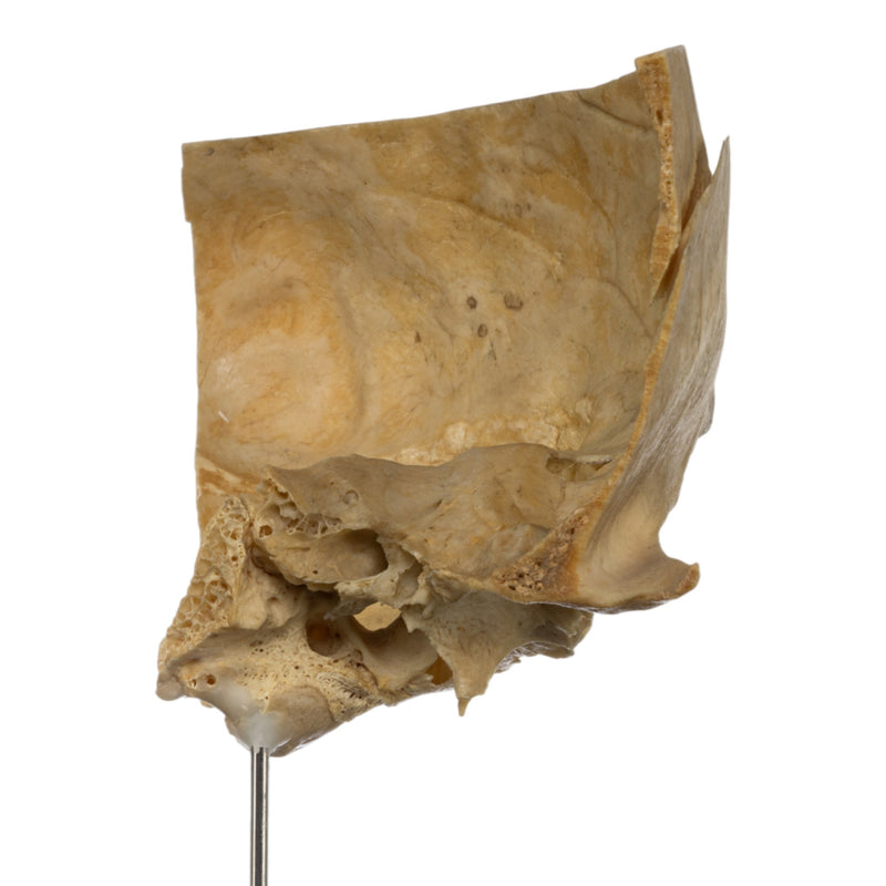 Real Human Partial Skull on Stand