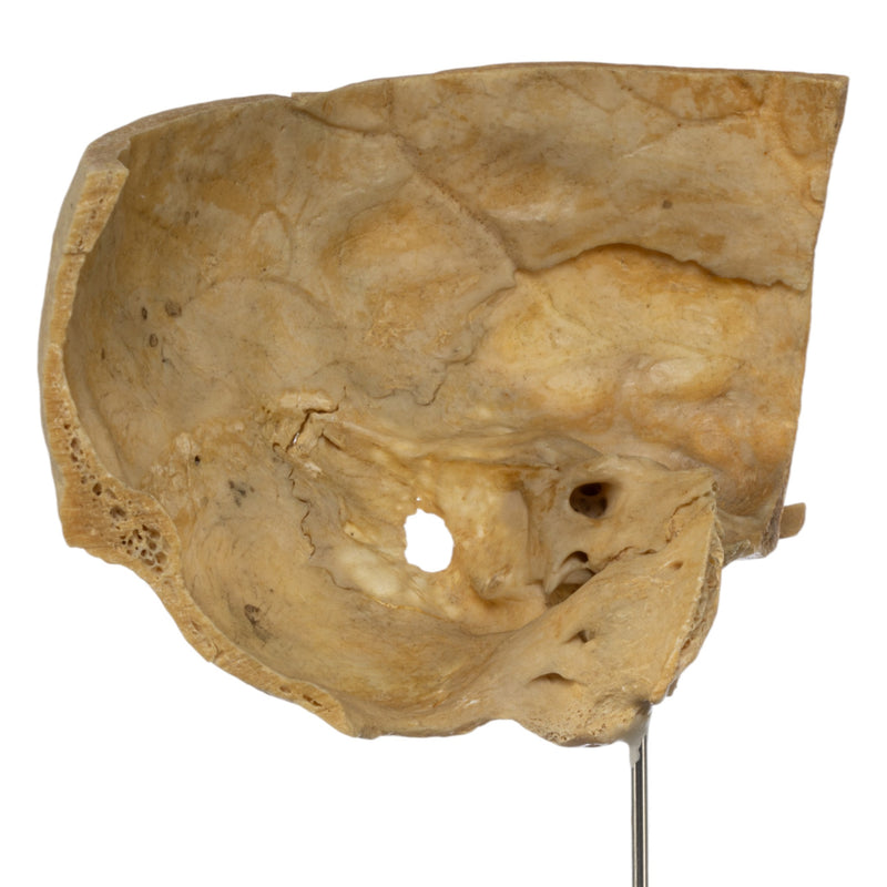 Real Human Partial Skull on Stand