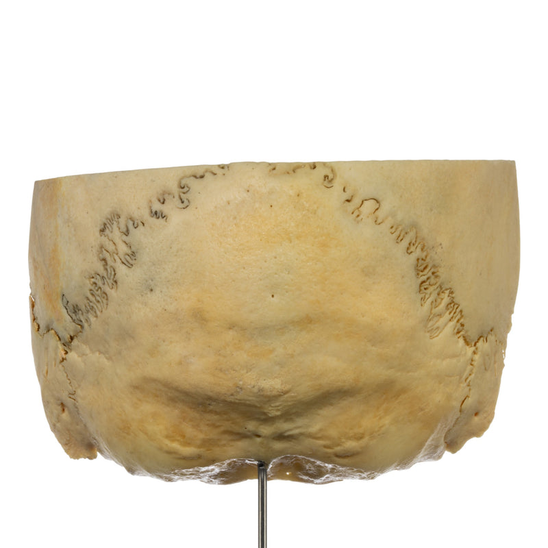 Real Human Partial Skull on Stand