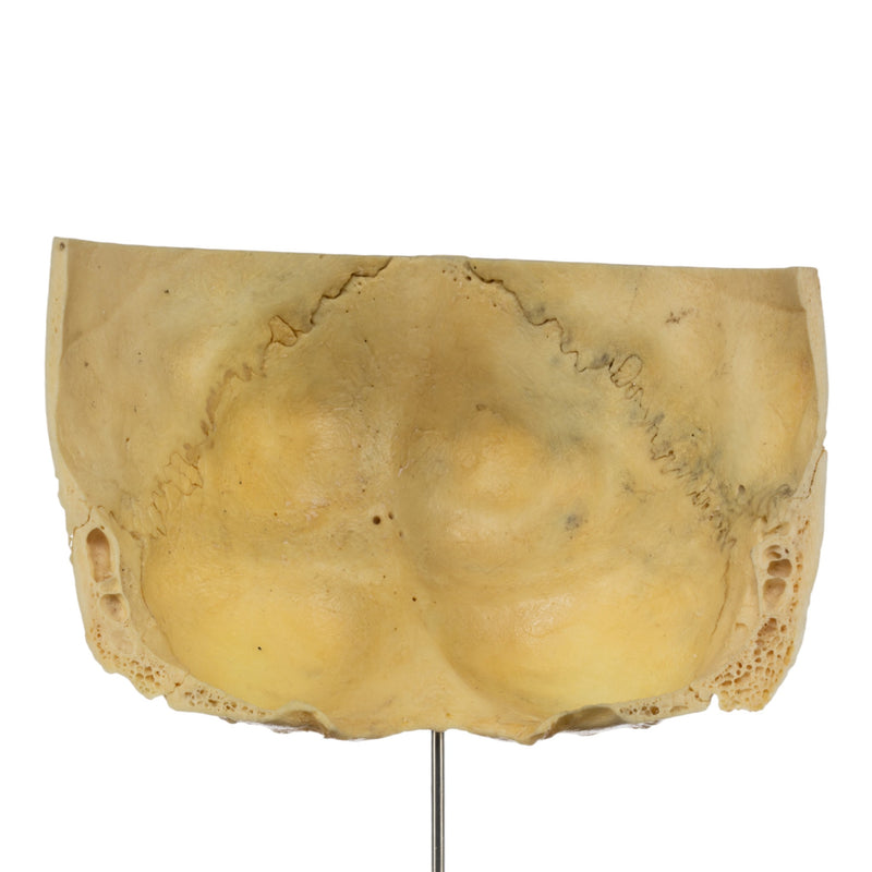 Real Human Partial Skull on Stand