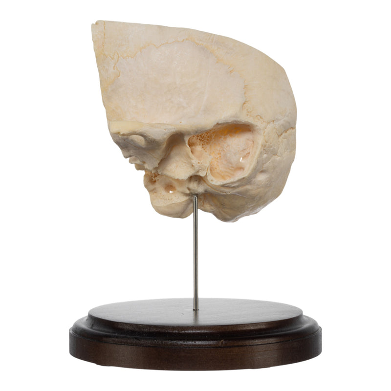 Real Human Partial Skull on Stand