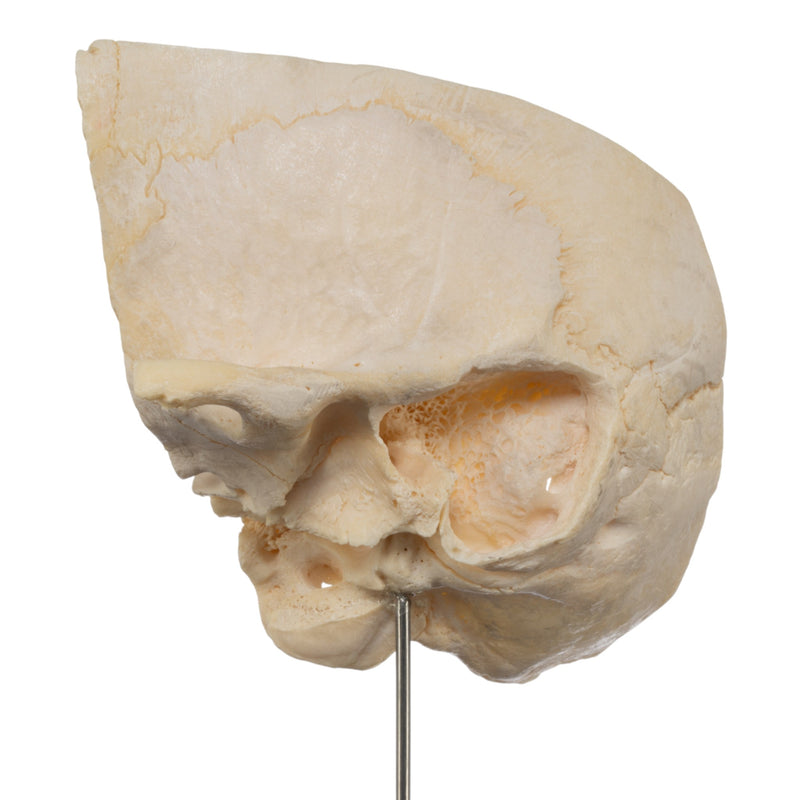 Real Human Partial Skull on Stand