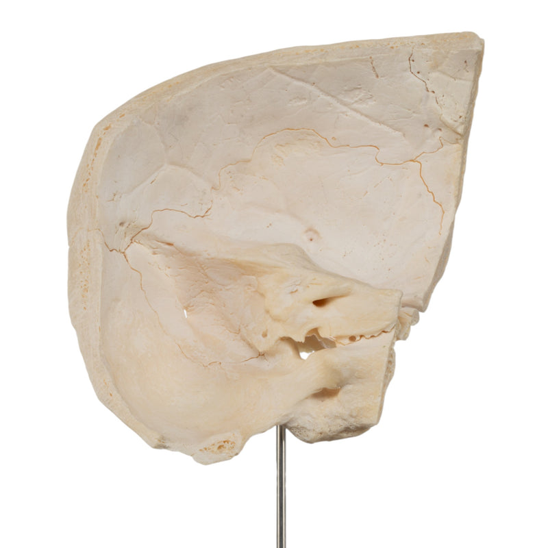 Real Human Partial Skull on Stand