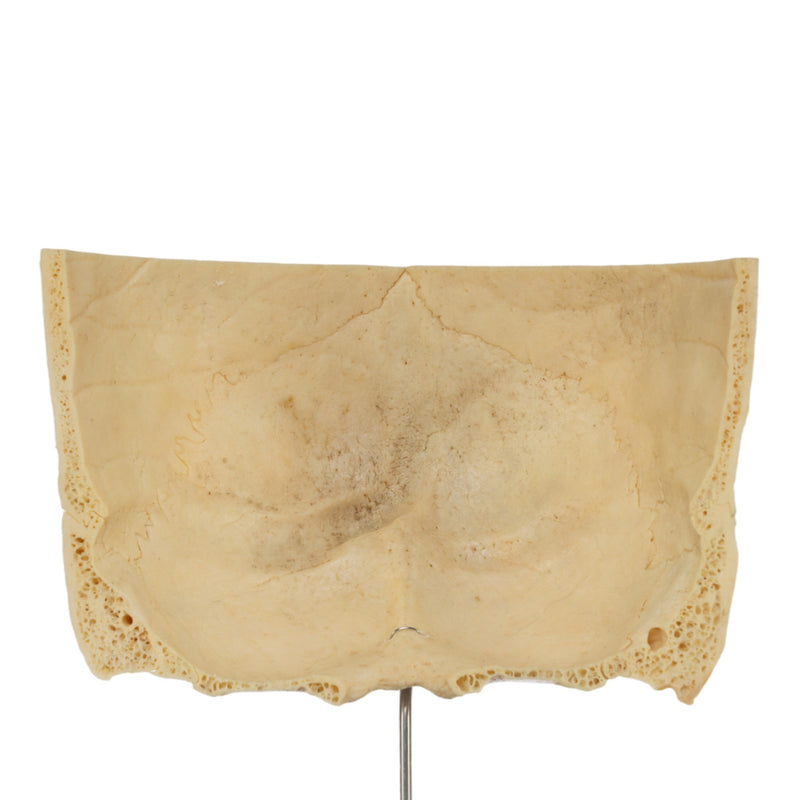 Real Human Partial Skull on Stand