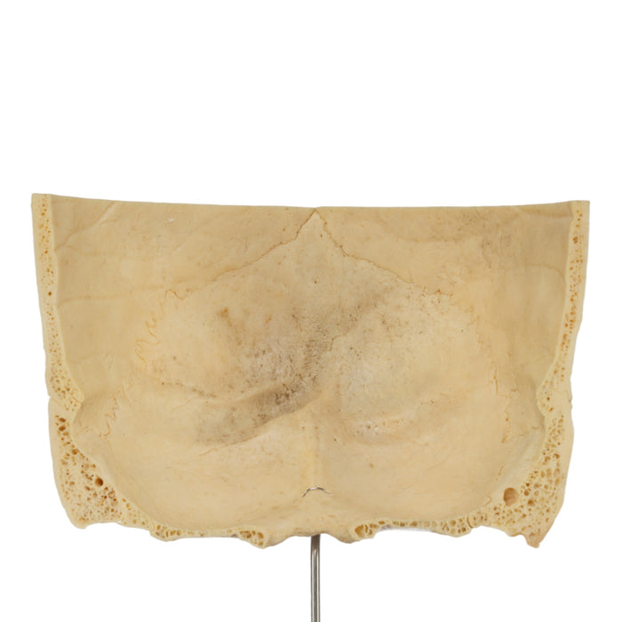 Real Human Partial Skull on Stand