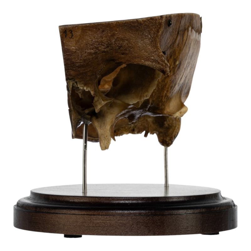 Real Human Partial Skull on Stand