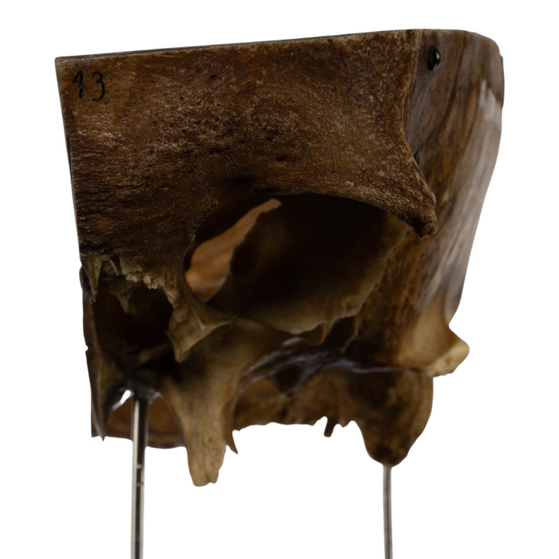 Real Human Partial Skull on Stand