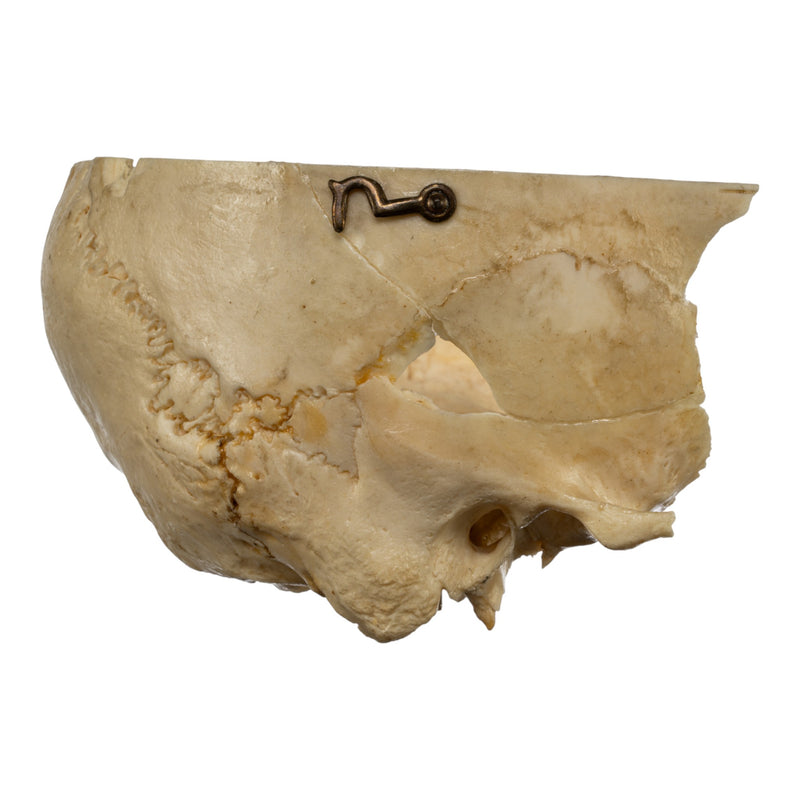 Real Human Partial Skull on Stand