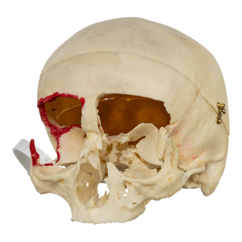 Real Human Skull - No Mandible For Sale — Skulls Unlimited