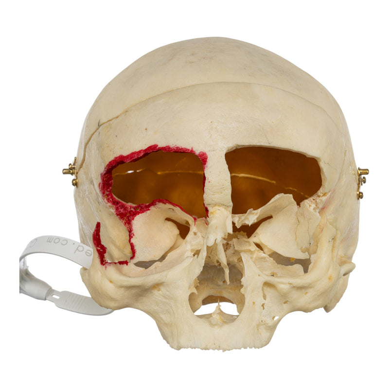 Real Human Skull - No Mandible