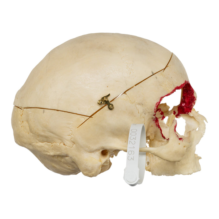 Real Human Skull - No Mandible