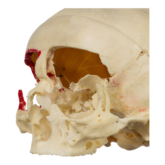 Real Human Skull - No Mandible