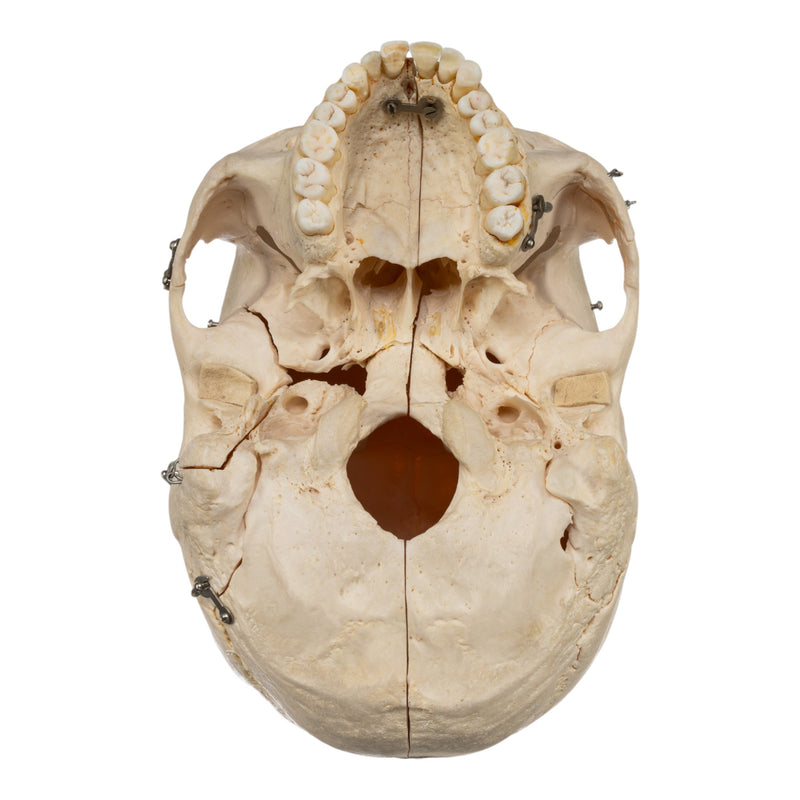 Real Human Skeleton - Disarticulated