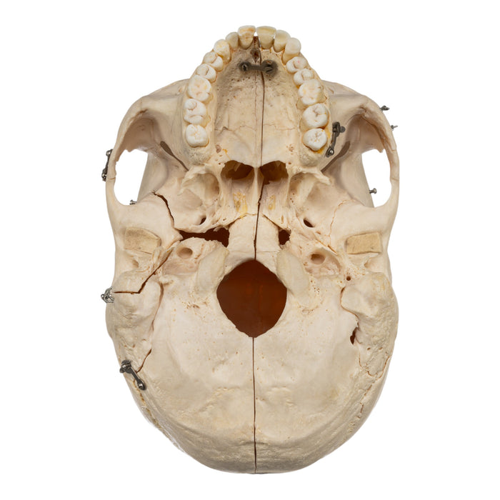 Real Human Skeleton - Disarticulated