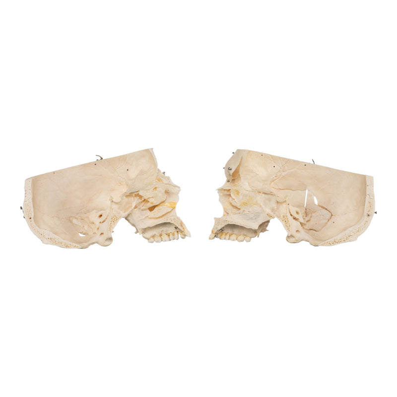 Real Human Skeleton - Disarticulated