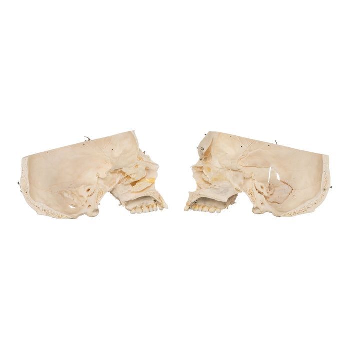 Real Human Skeleton - Disarticulated