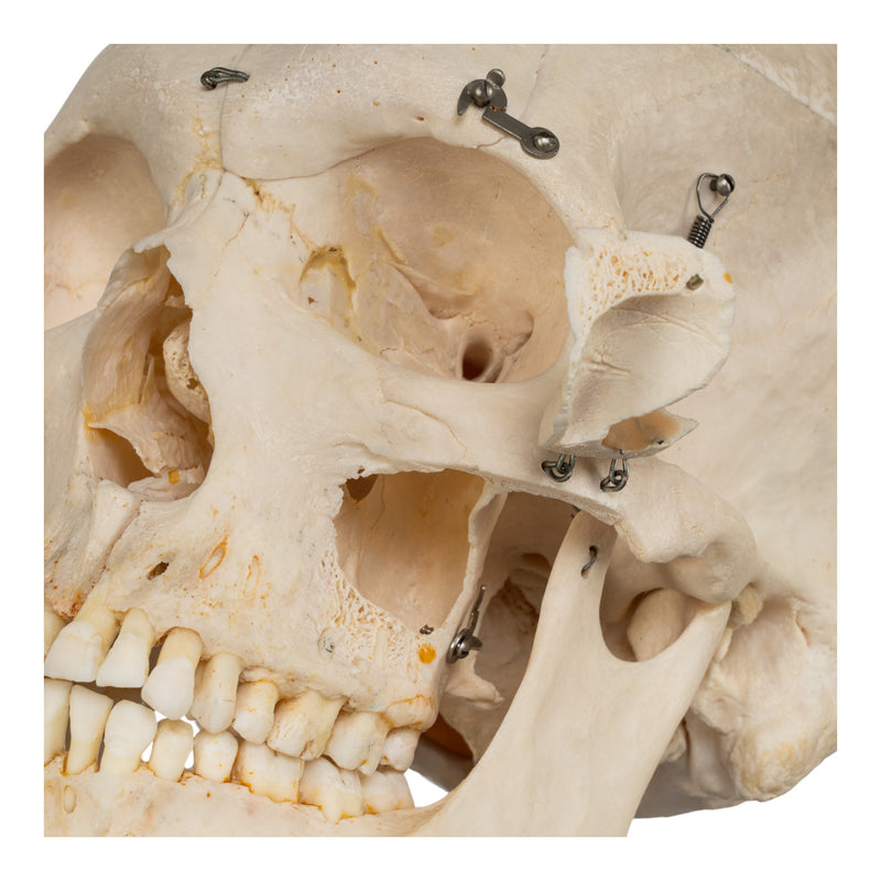 Real Human Skeleton - Disarticulated