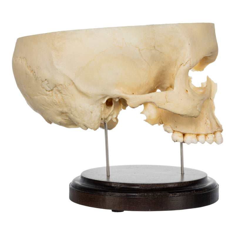 Real Human Partial Skull on Stand