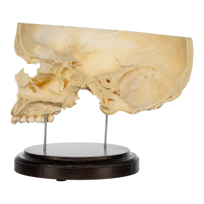 Real Human Partial Skull on Stand