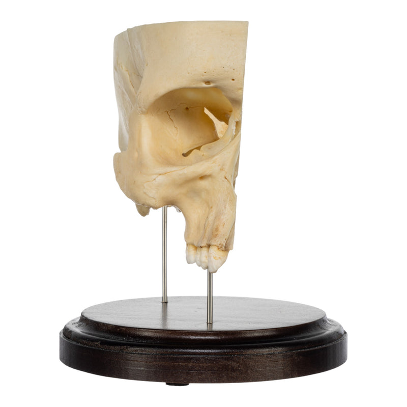 Real Human Partial Skull on Stand