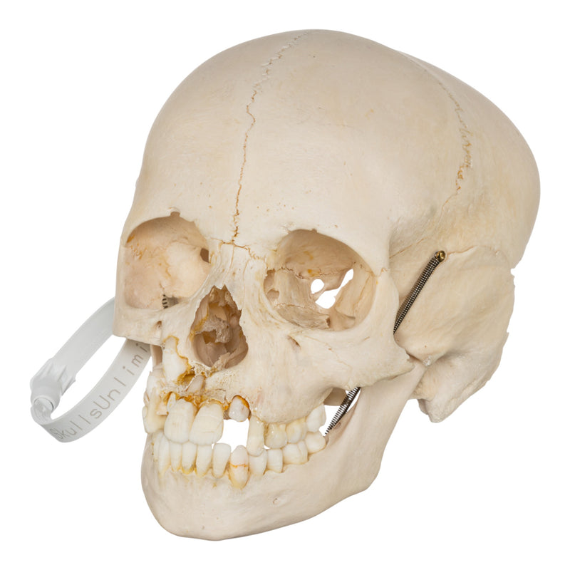 Real Human Child Skull - Damaged