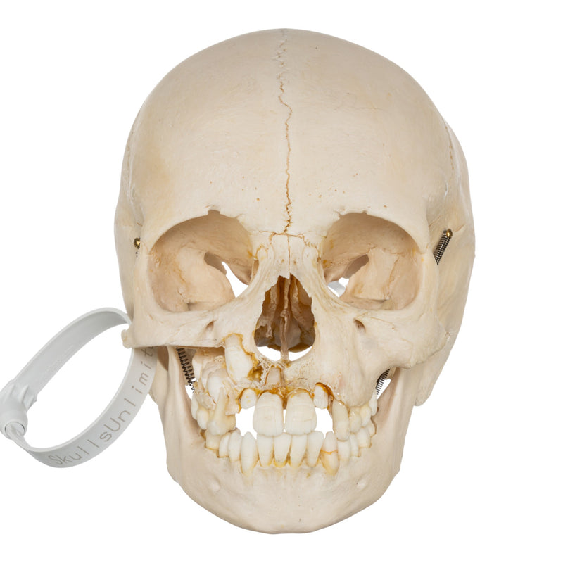 Real Human Child Skull - Damaged