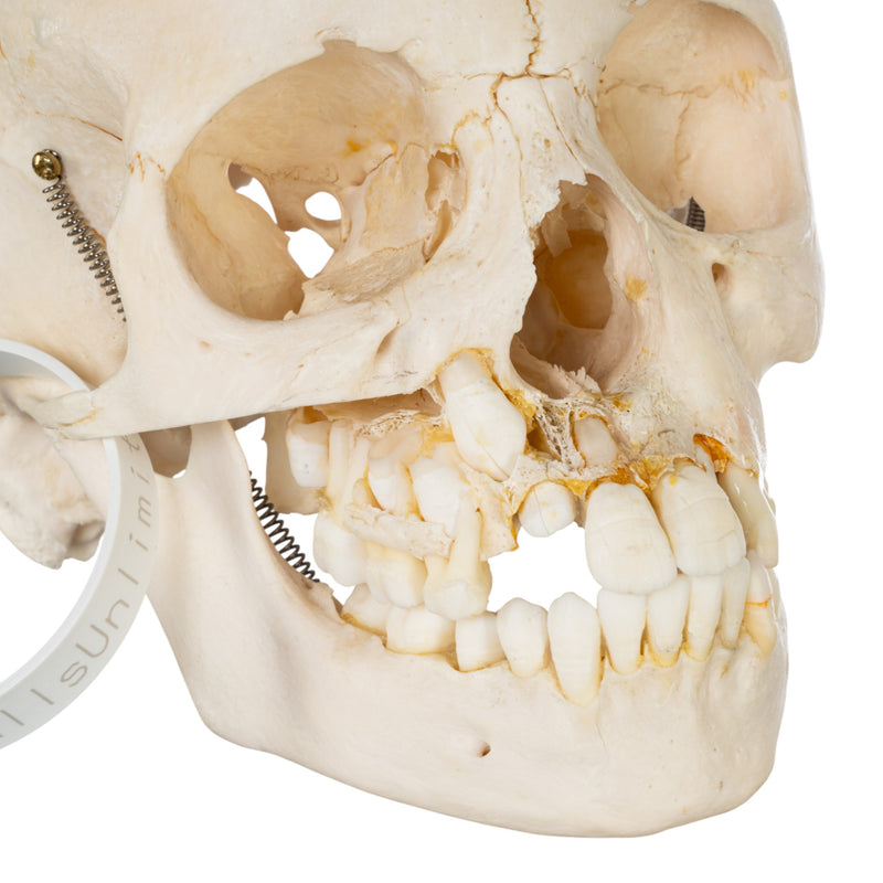 Real Human Child Skull - Damaged