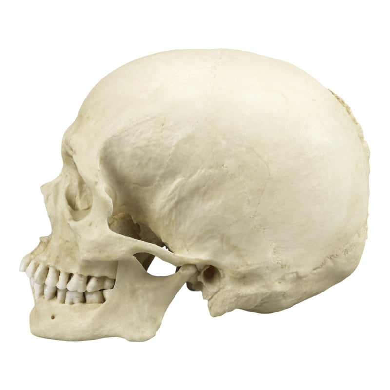 Replica Human Skull with Syphilis