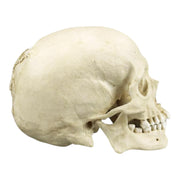 Replica Human Skull with Syphilis