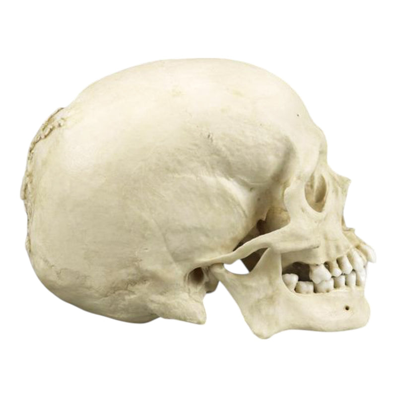 Replica Human Skull with Syphilis