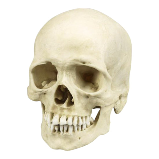 Replica Human Skull with Syphilis