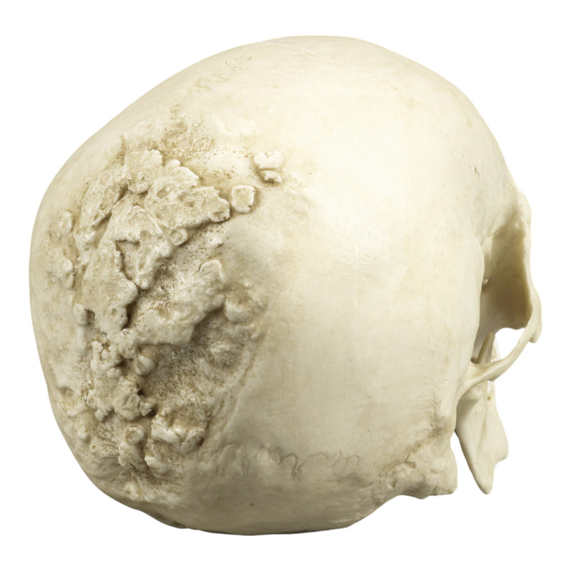 Replica Human Skull with Syphilis
