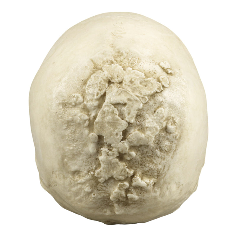 Replica Human Skull with Syphilis
