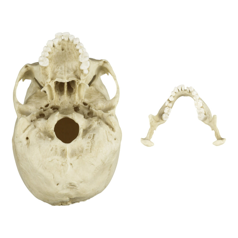 Replica Human Skull with Syphilis