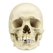 Replica Human Skull with Syphilis