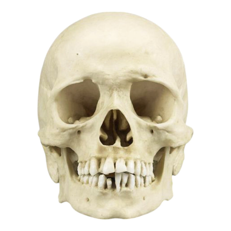 Replica Human Skull with Syphilis