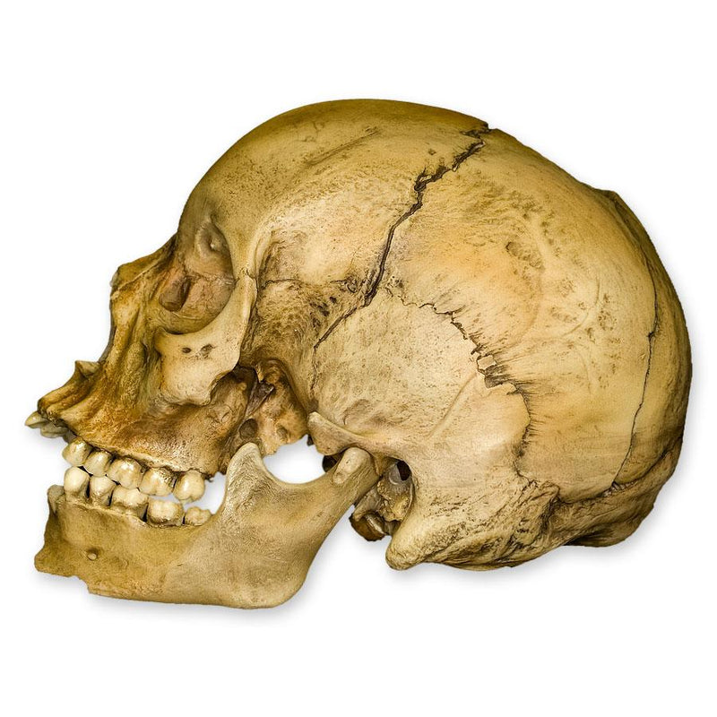 Replica Human Female with Shotgun Wounds Skull