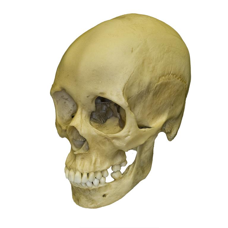 Replica Human Female with Multiple Gunshot Wounds Skull For Sale