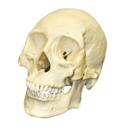 Replica Human Skull - Healed Trauma