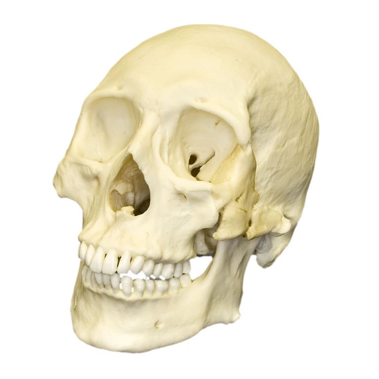 Replica Human Skull - Healed Trauma