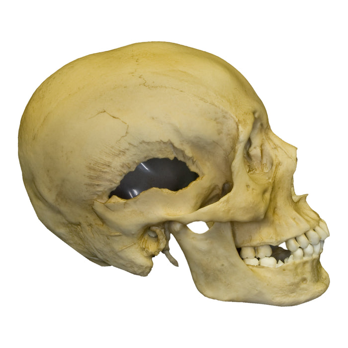 Replica Human Female with Multiple Gunshot Wounds Skull