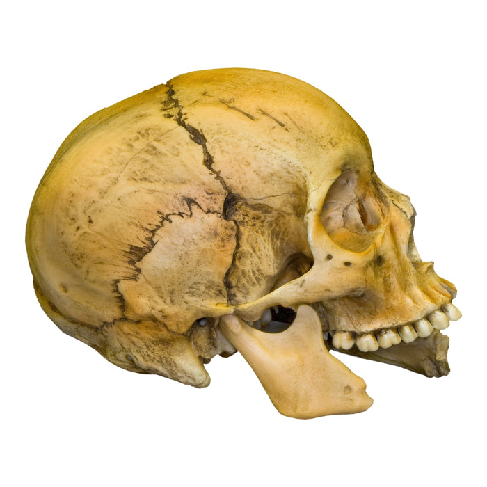 Replica Human Female with Shotgun Wounds Skull