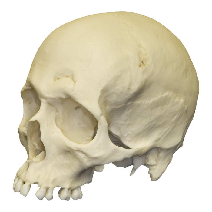 Replica Human Male Skull with Hammer Blows