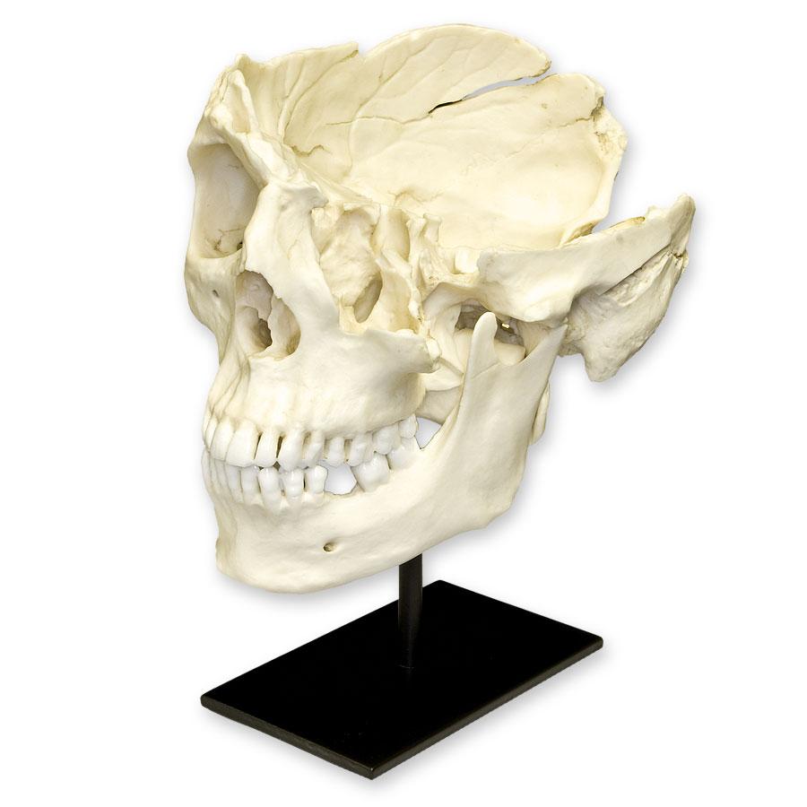 Replica Human Male with Machete Wounds Skull For Sale — Skulls
